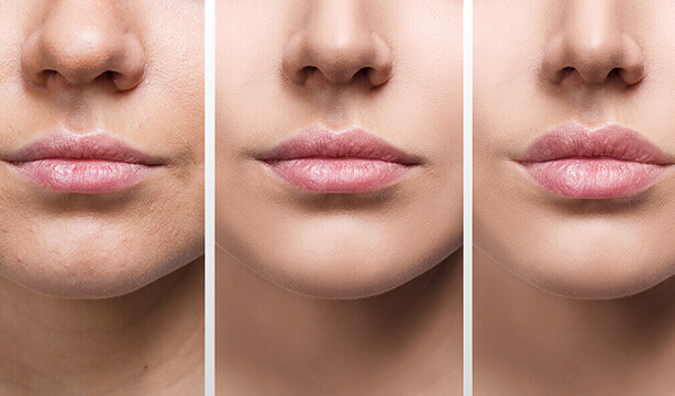 Non Invasive Alternatives for Lip Augmentation