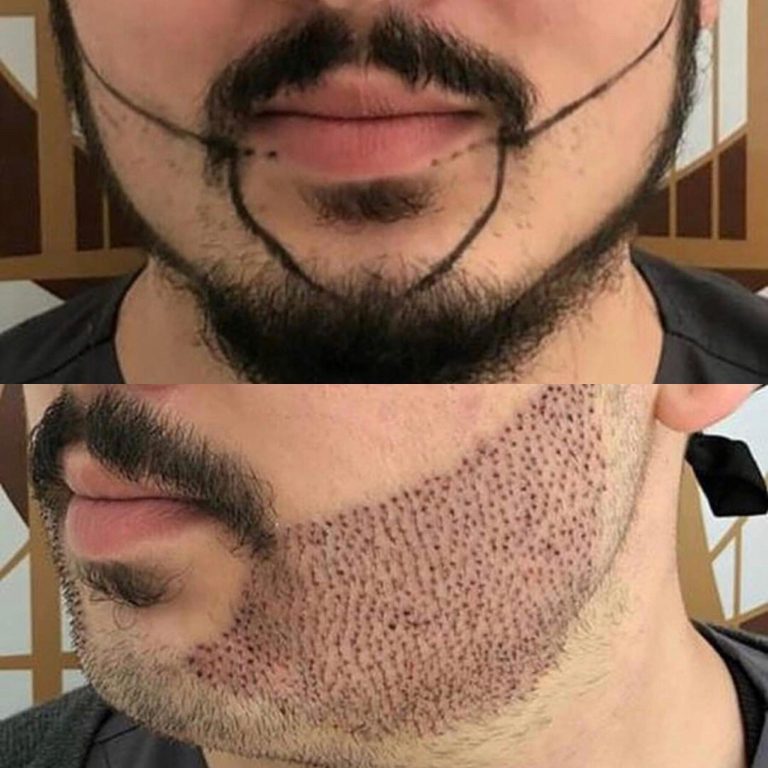 Facts which you should know about beard transplant in Gurgaon