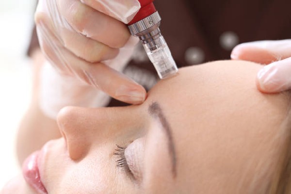 Microneedling: Benefits and Possible Risks Involved