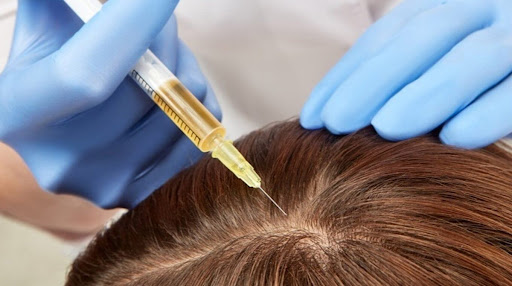 What Is Hair Loss Treatment