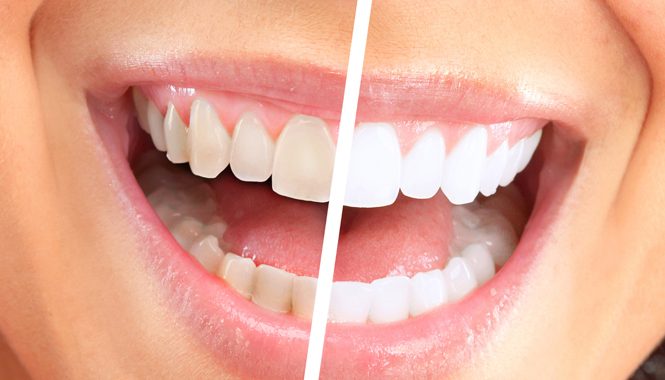 Few Secrets about Teeth Whitening