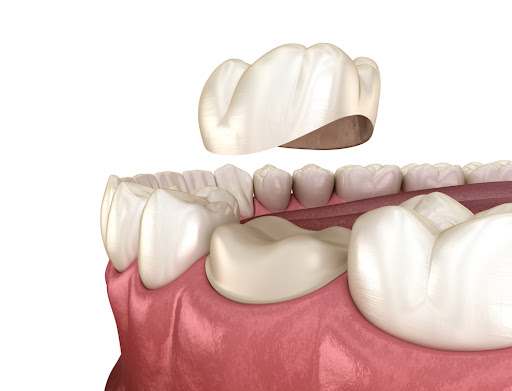 Features of Dental Tooth Crown