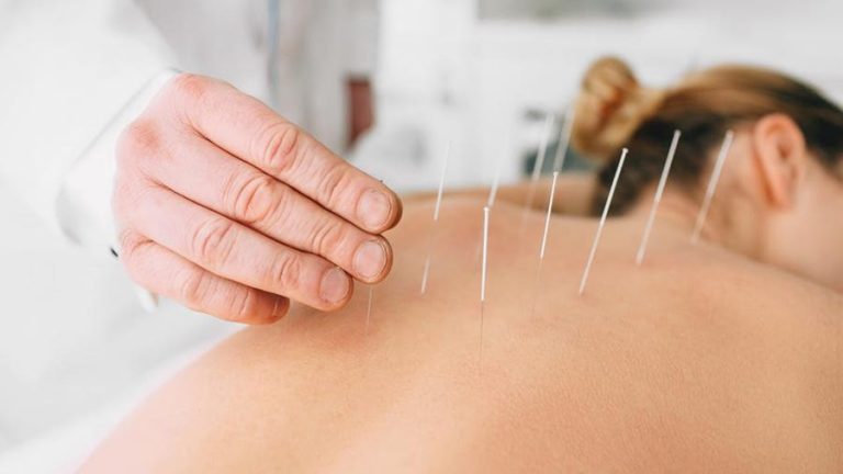 Top 3 Benefits of Acupuncture