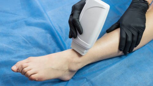 The Vascular and Interventional Centre: Treating Varicose Veins